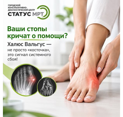 Hallux Valgus: почему «косточка» на стопе — не главная проблема