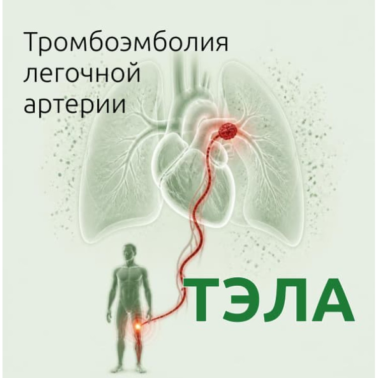 ТЭЛА: как тромб из ноги останавливает сердце и что делать